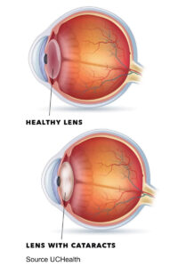 Cataracts image copy