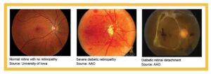 _diabetic-retinopathy-